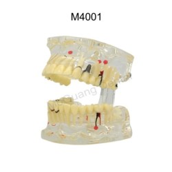 Dental Teeth Model Implant with Removable Dental Education Model for Dentistry Laboratory Demo Studying Dentistry Products Tool