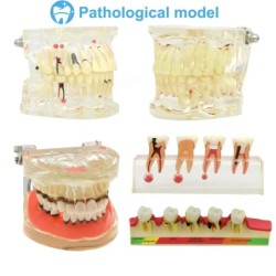 Dental Teeth Model Implant with Removable Dental Education Model for Dentistry Laboratory Demo Studying Dentistry Products Tool