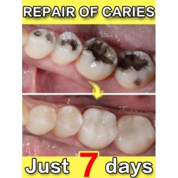 Solve caries and tooth decay and protect anti caries teeth